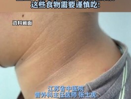 福州13岁男孩体重近200斤，脖子发黑竟是这种病？快了解